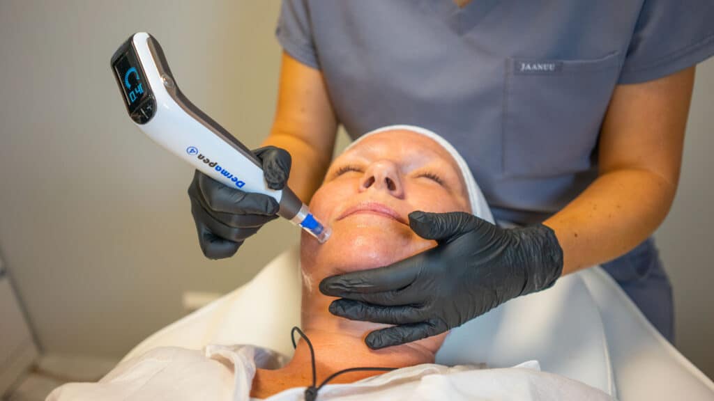 dermapen akne