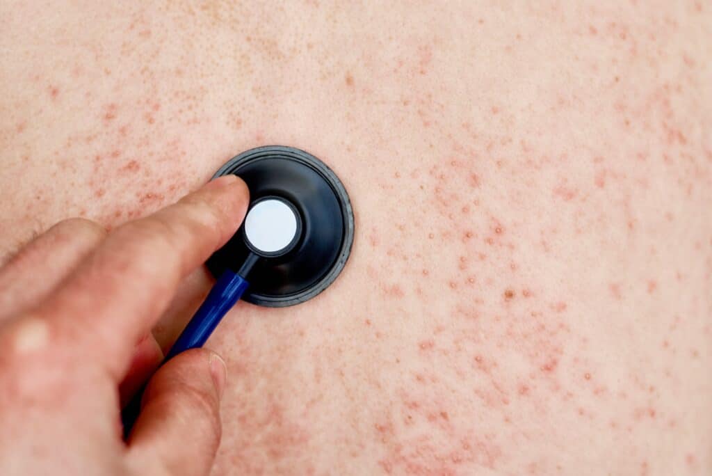 Allergic rash on skin. Woman with dermatology problem on back skin