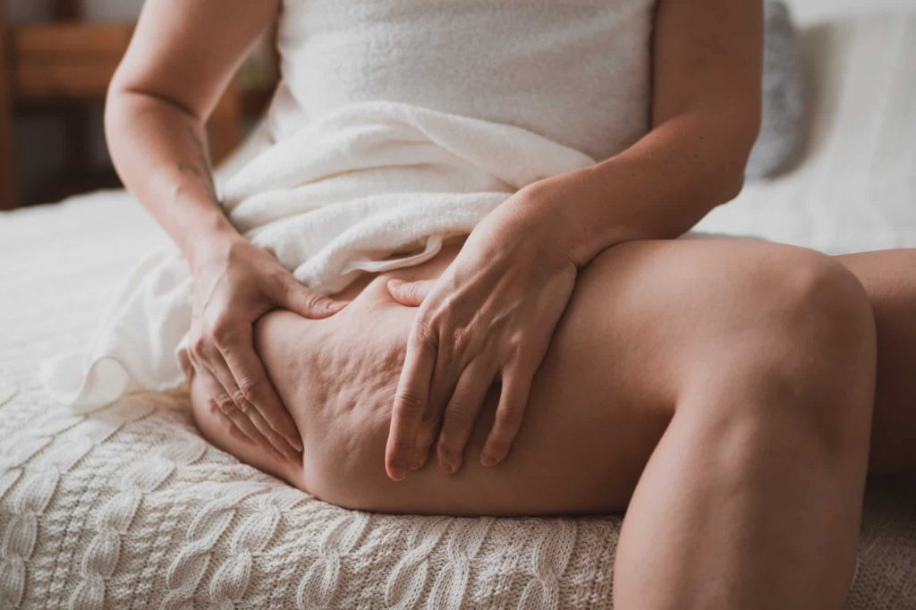 Close-up of female body with cellulite, woman makes massage against cellulite with her hands.