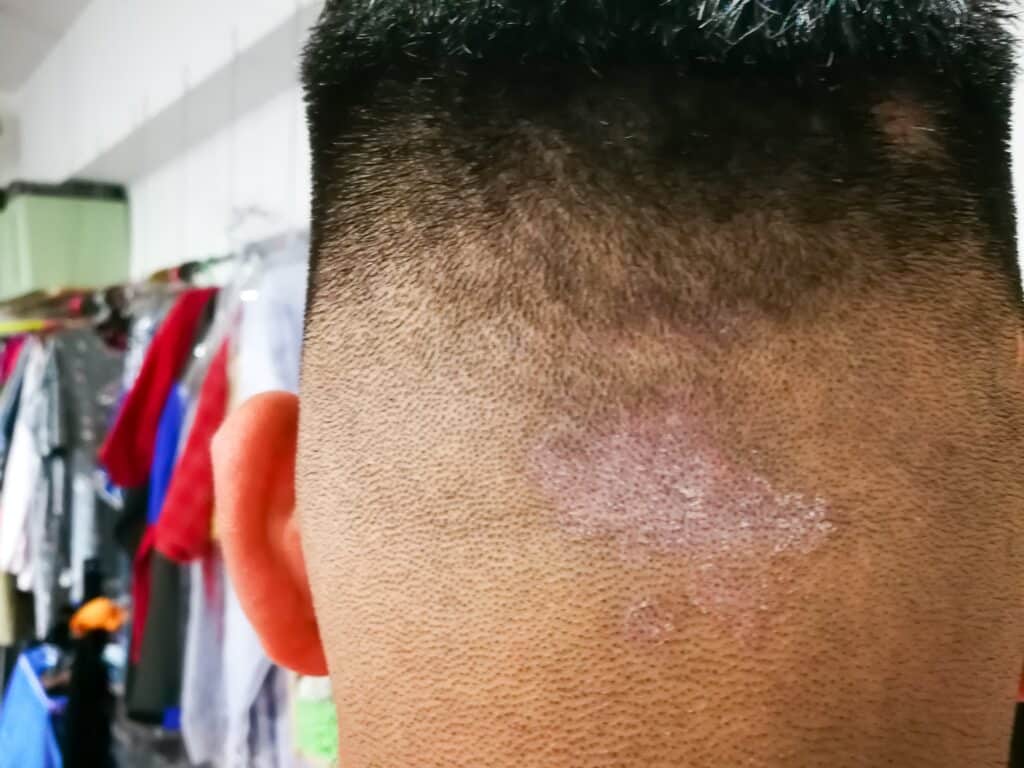 Closed up of ringworm also known as tinea on the scalp of the head. Dermatitis problem.