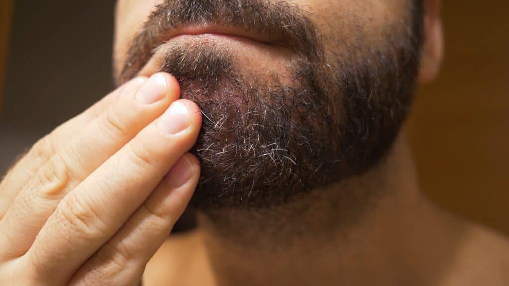 Detail of the man's chin with seborrheic dermatitis in the beard area.