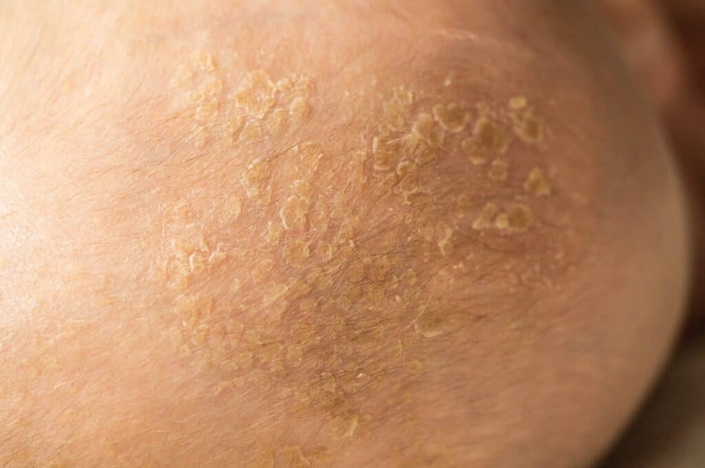 erythema infectiosum