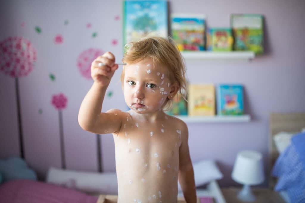 Little girl with chickenpox, antiseptic cream applied to rash
