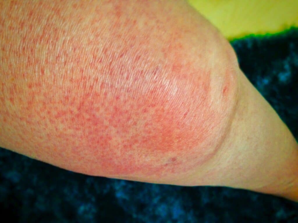 MEDICAL ALLERGY : URTICARIA (HIVES) CLOSEUP OF SWOLLEN FEMALE LEG; ITCHY AND PAINFUL RASH