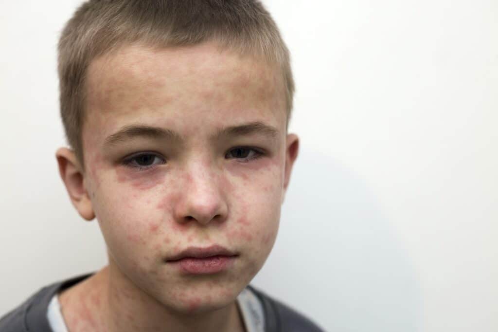 Portrait of sick sad boy child suffering from measles or chicken pox