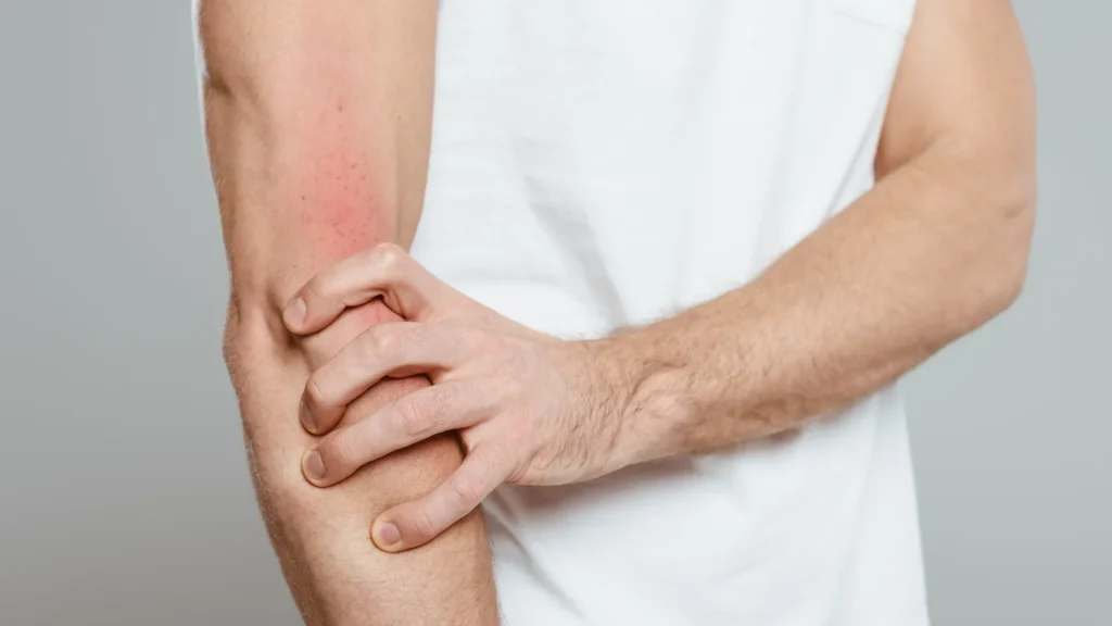 En mann med en hvit t-skjorte holder over armen som er påvirket av atopi.