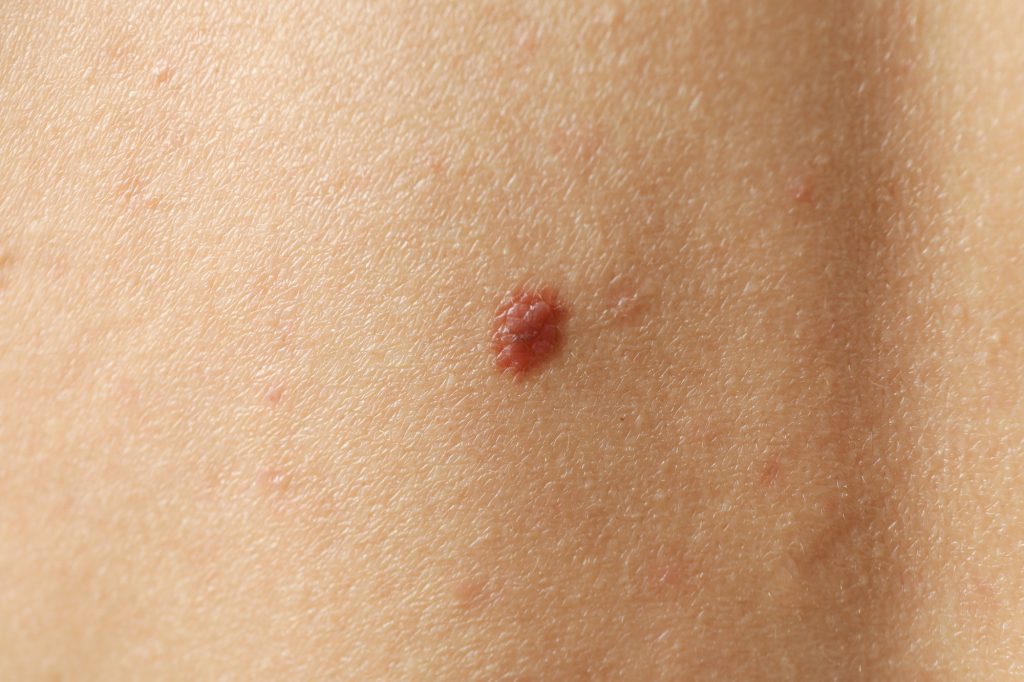 Concept of body care with skin with mole