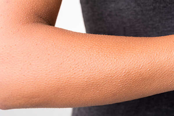 En dame med nuppete hud.