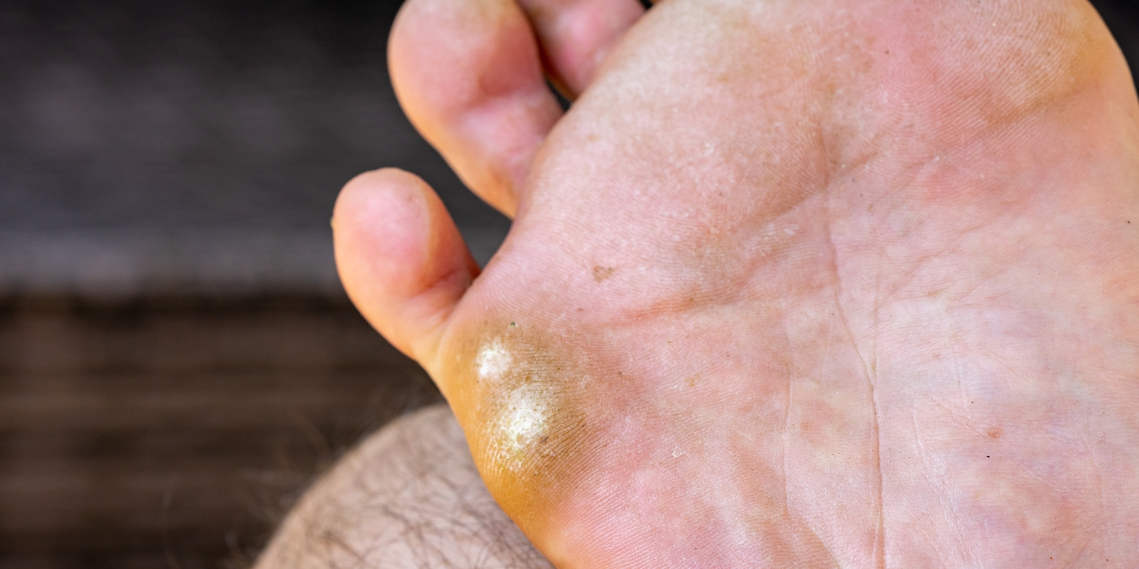 Bilde av tinea pedis.