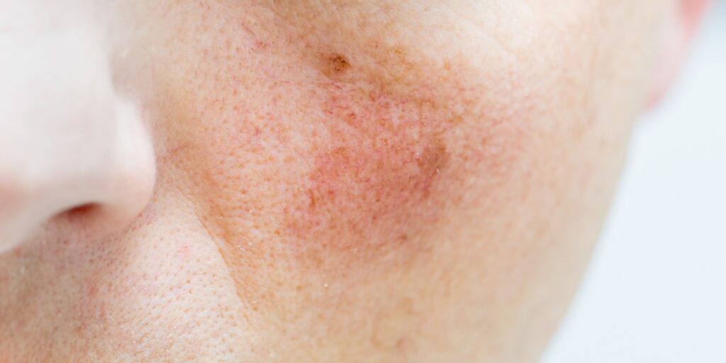 Et rødt merke på kinnet til en dame.