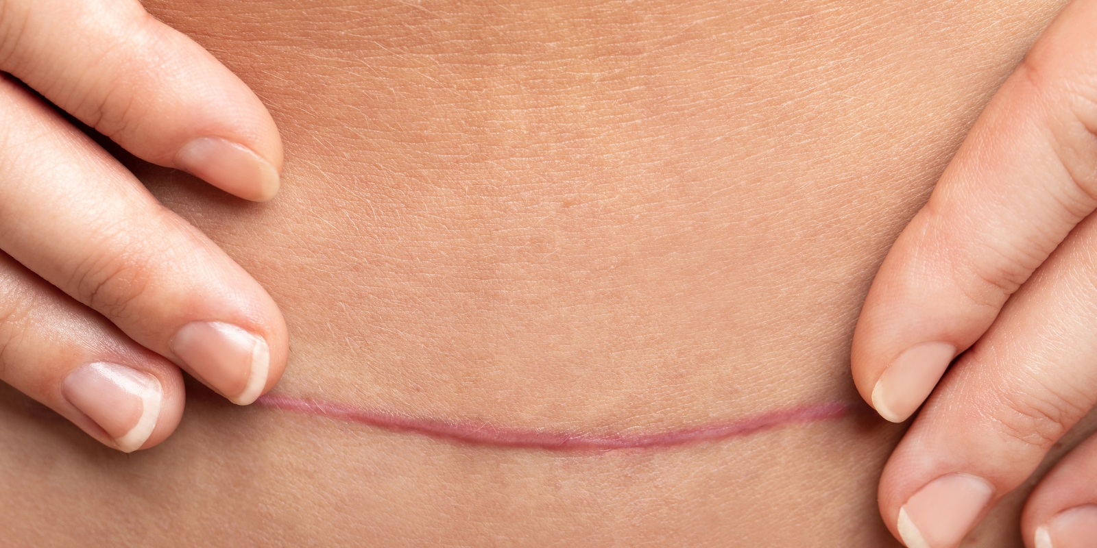 Bilde av et arr under navlen.