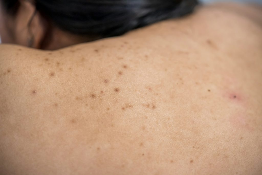 Acne on the back of the skin care woman is caused by bacteria.