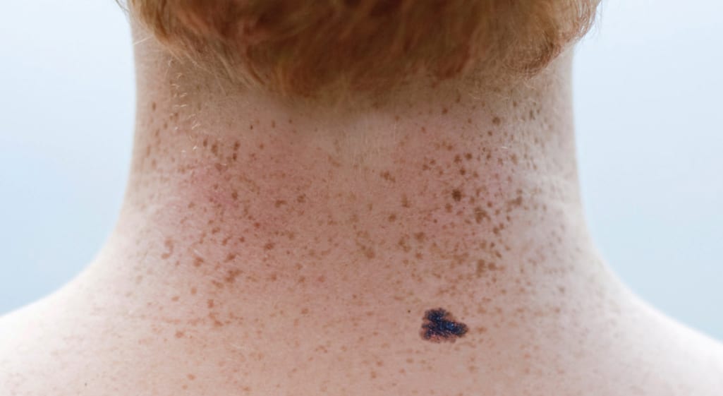 Føflekkreft i nakken