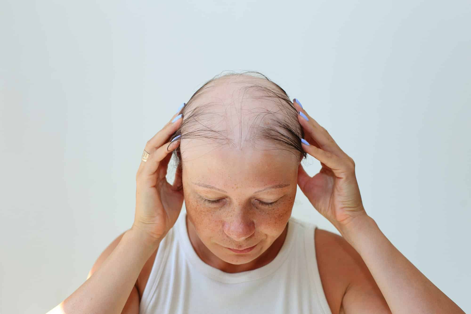 Hair loss in the form of alopecia areata.