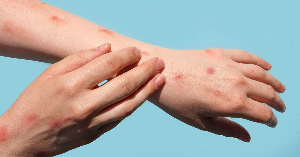 Apekopper på armene, MPOX