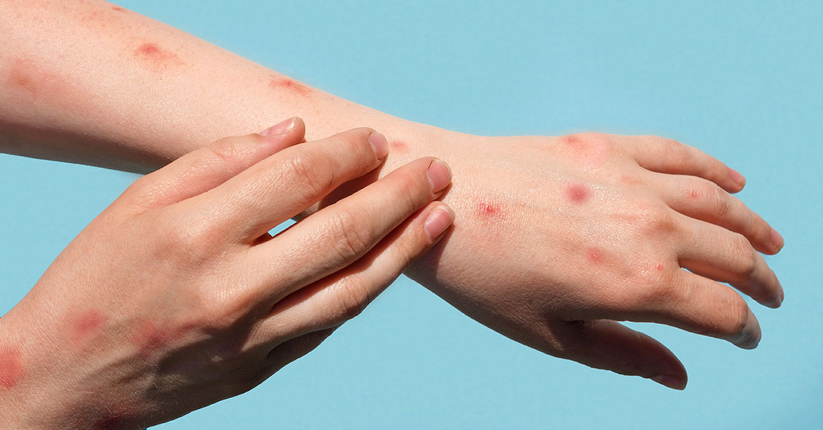 Apekopper på armene, MPOX