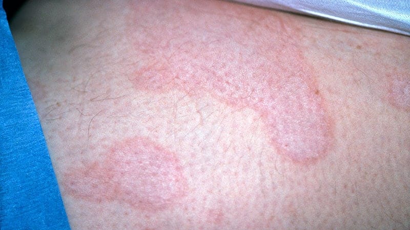 Lichen sclerosus på beinet