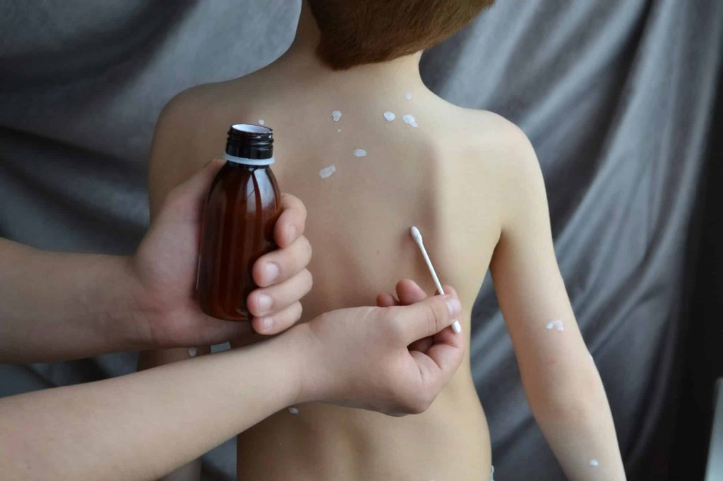 chickenpox. Dad administering antipruritic white lotion to the virus for smallpox symptoms