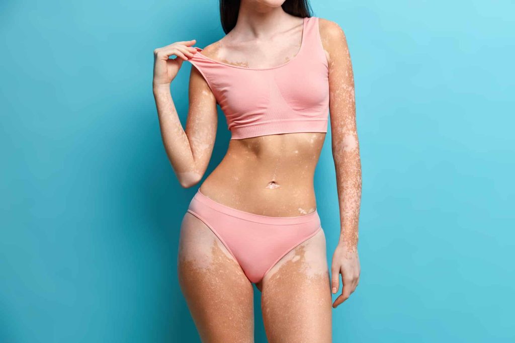 Photo of unrecognizable woman in cropped top and panties has vitiligo pigments special skin perfect